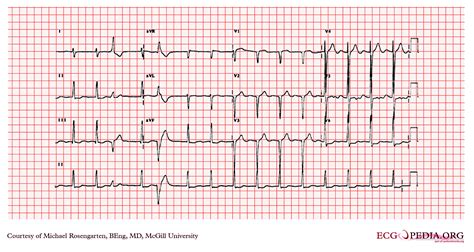 left ventricular hypertrophy on ecg